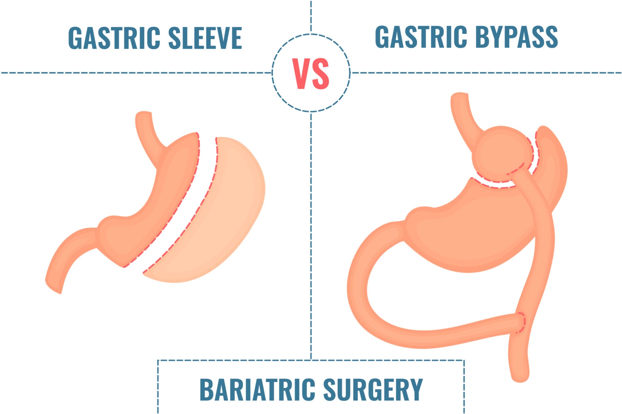 Bariatric Surgery - Benefits, Risks & Who Should Consider It