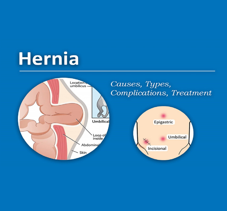 Hernia treatment in Pune | Dr. Shrikant Kurhade