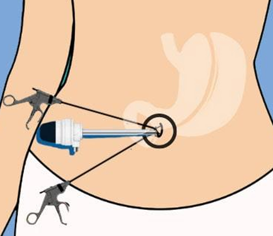 Single Incision Laparoscopic Surgery in Pune | Dr. Shrikant Kurhade