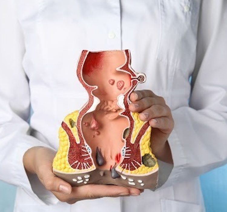 Stapler Surgery for Piles in Pune | Dr. Shrikant Kurhade