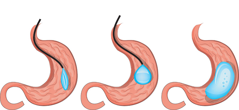 Intragastric Balloon Treatment