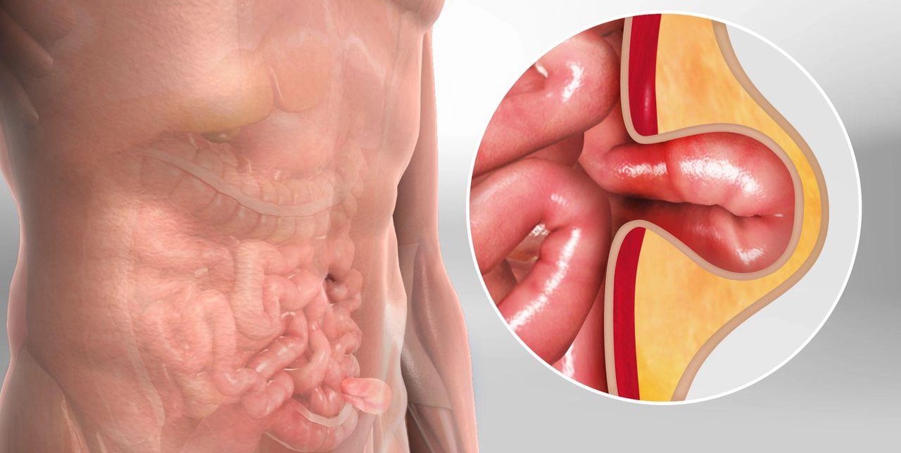 Laparoscopic Hernia Surgery