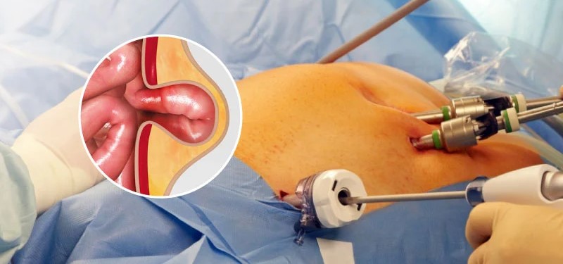 Hernia and laparoscopic surgery guide
