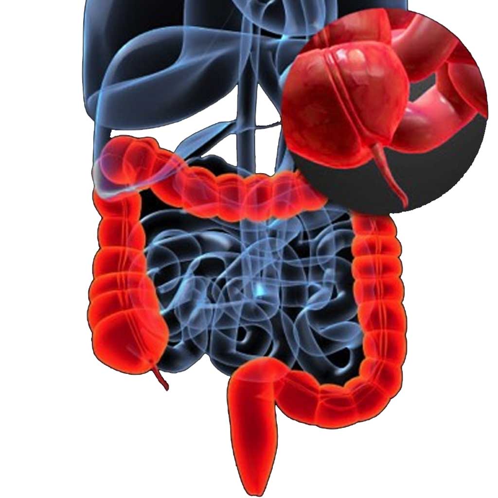 Intragastric_Balloon