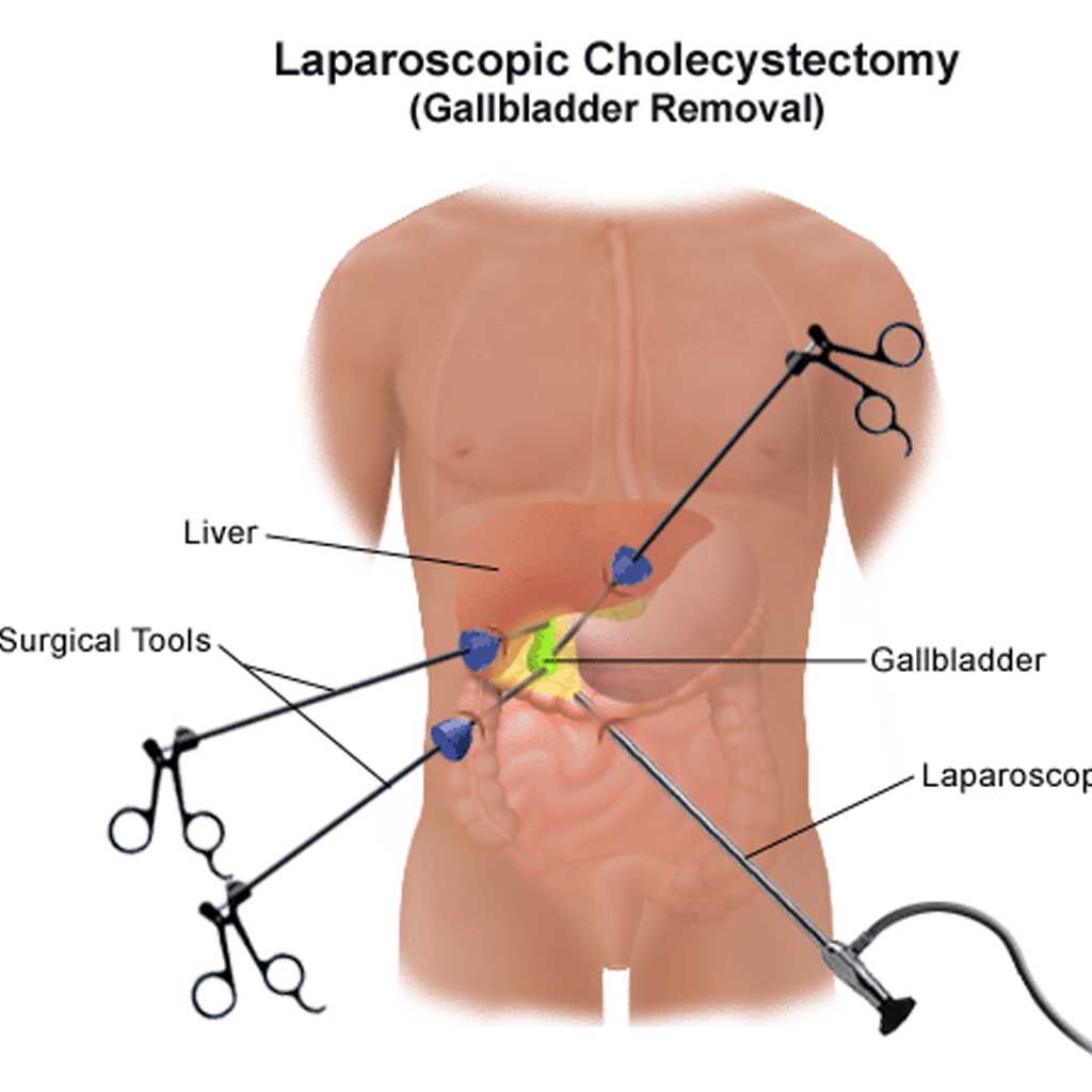 Intragastric_Balloon