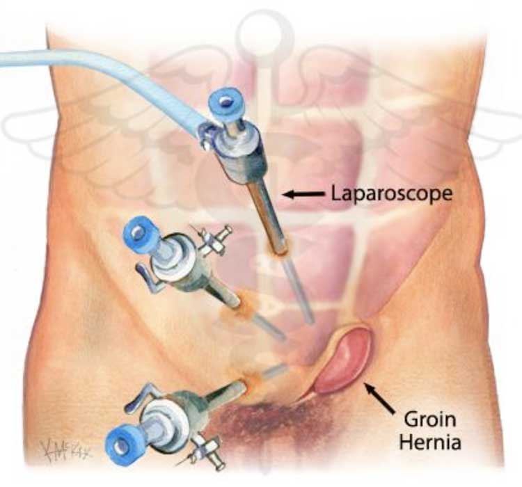 Intragastric_Balloon