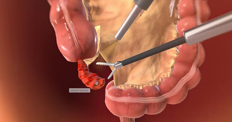 Laparoscopic surgery in India - Dr Shrikant Surgeon
