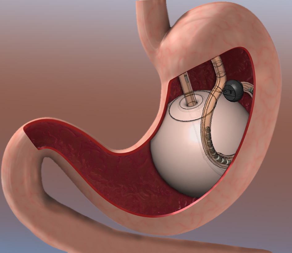 Intragastric balloon robotic Surgery in India - Dr Shrikant Surgeon